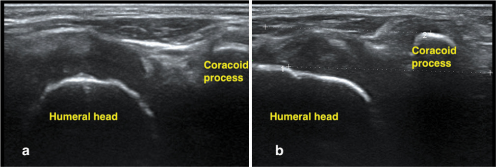 Ultrasound image of a normal shoulder (a,b) highlighting the coracoid process positioned superior to and parallel to the humeral head, reflecting typical anatomical alignment.