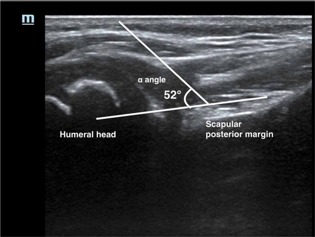 Depiction of the α angle, formed between the posterior margin of the scapula and a line tangential to the humeral head and posterior glenoid edge.