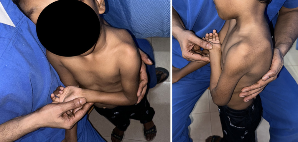 The reverse putti sign is demonstrated by the superior migration of the scapula during shoulder adduction and internal rotation, indicating a glenohumeral adduction contracture.