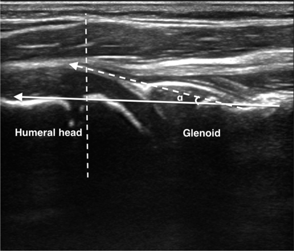 Ultrasound image of the shoulder demonstrating normal anatomical structures, with no signs of subluxation or other abnormalities. The α angle is formed between the posterior margin of the scapula (solid line arrow) and a line tangential to the posterior humeral head (dotted line).