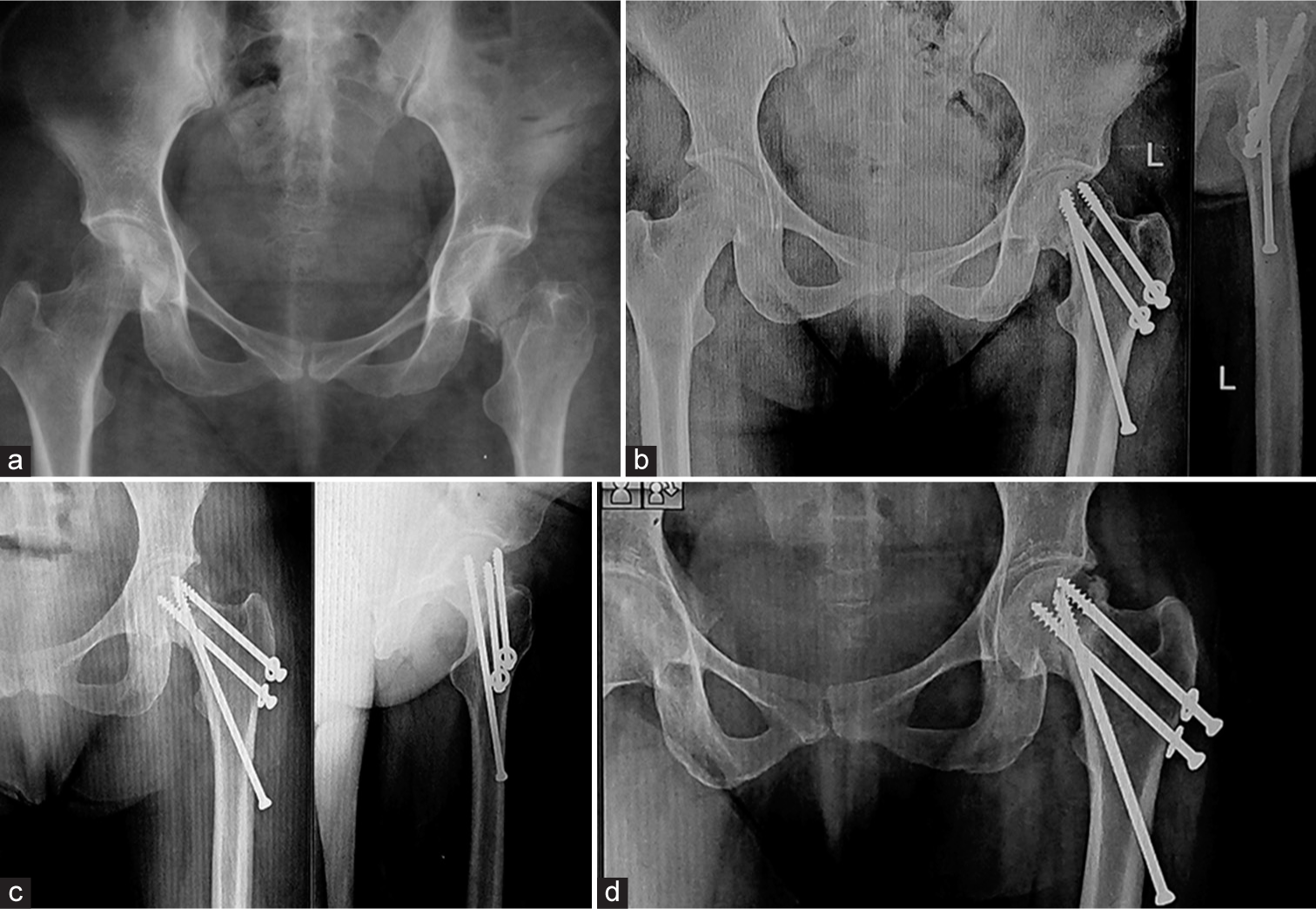 Challenges Of Biplane Double-supported Screw Fixation Technique For 