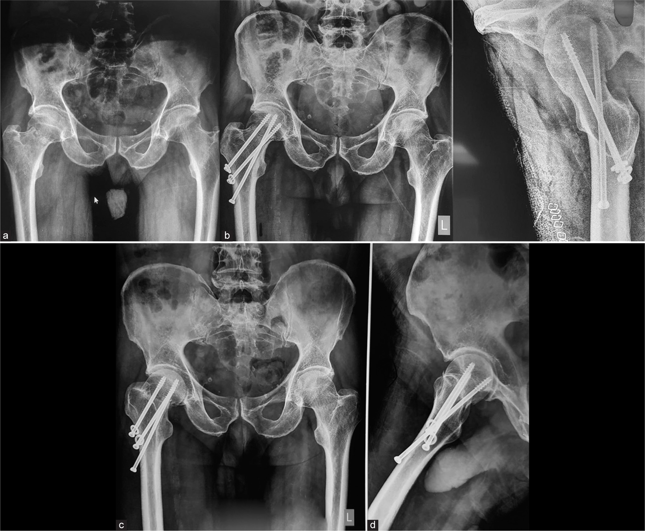 (a) Radiograph showing right side neck of femur fracture. (b) Immediate postoperative AP and lateral radiographs. (c, d) Six months follow-up radiographs, AP and lateral, showing varus collapse of the head and screw back out.