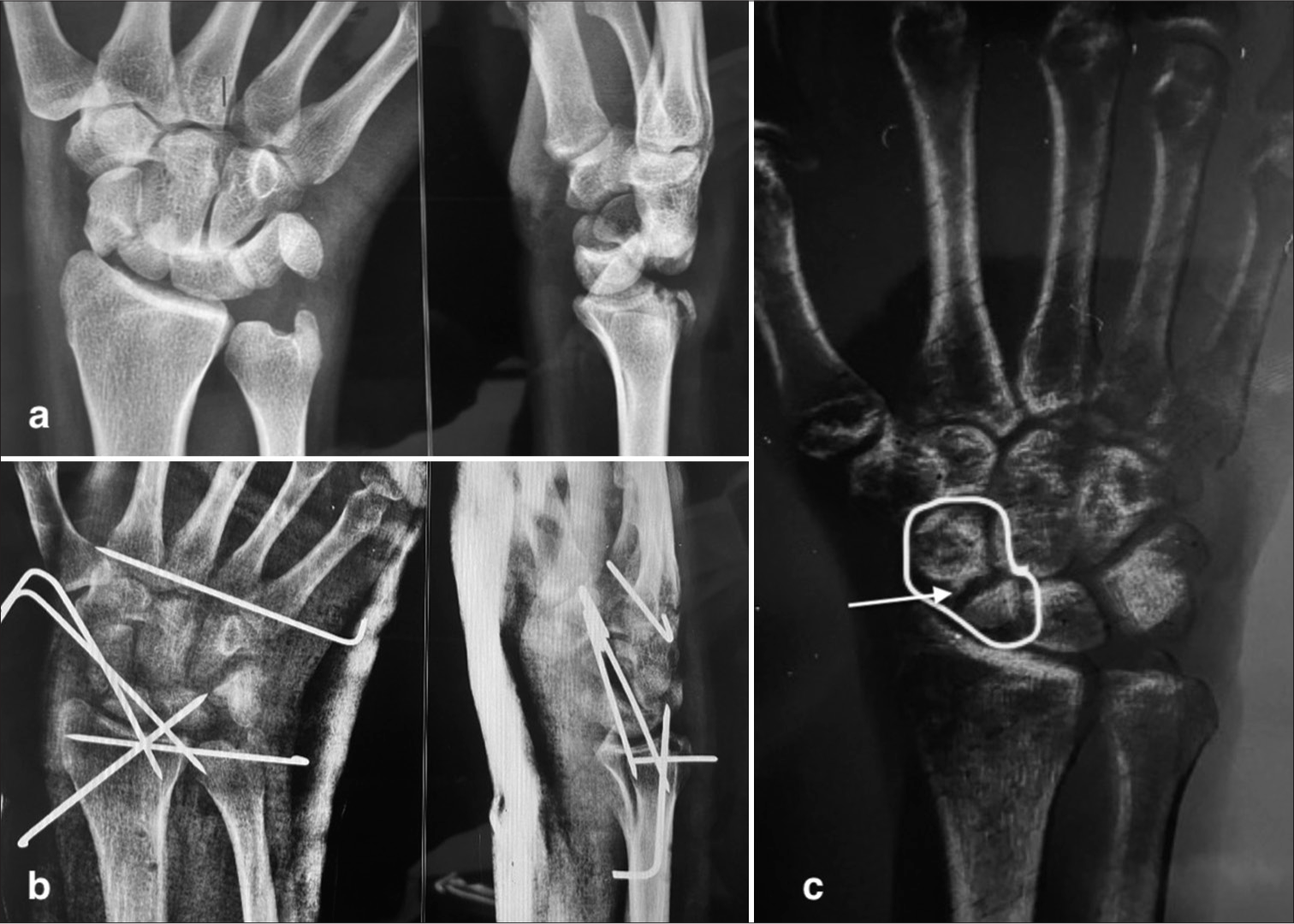 Trans-scaphoid perilunate fracture dislocation: Initial treatment and subsequent complications (a) Pre-operative radiograph: Demonstrates a trans-scaphoid perilunate fracture-dislocation in a 30-year-old man. (b) Post-operative radiograph: Shows the initial treatment with closed reduction and internal fixation using multiple K-wires. (c) Follow-up radiograph at 9 months: Reveals persistent scaphoid non-union despite K-wire removal at 6 weeks, accompanied by the patient’s reported pain and difficulty using the hand. This case underscores the challenges of managing perilunate injuries, even with initial surgical intervention. The development of scaphoid non-union (White arrow) highlights the importance of close follow-up and consideration of additional procedures, such as ligament repair or reconstruction, and headless compression screw fixation with bone grafting, to promote healing and restore function.