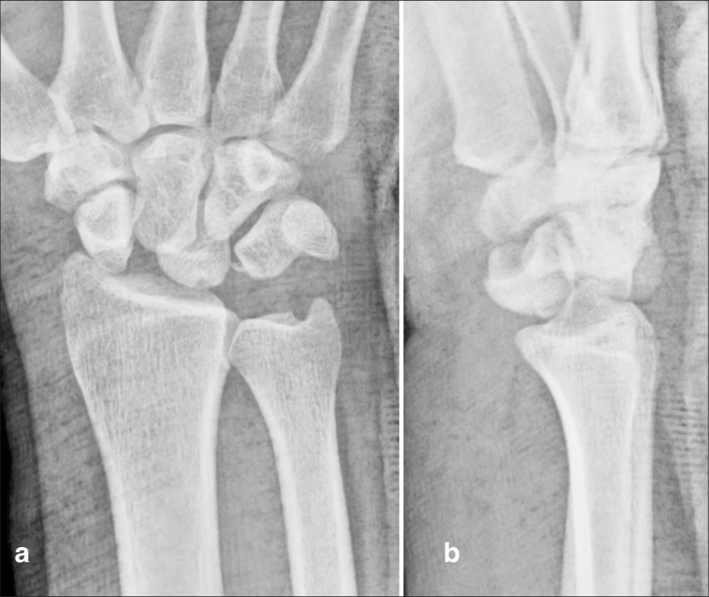 (a and b) Pre-operative radiographs of a 45-year-old man presenting with a 5-month-old neglected perilunate dislocation of the right wrist. Note the volar displacement of the lunate and associated median nerve dysfunction.