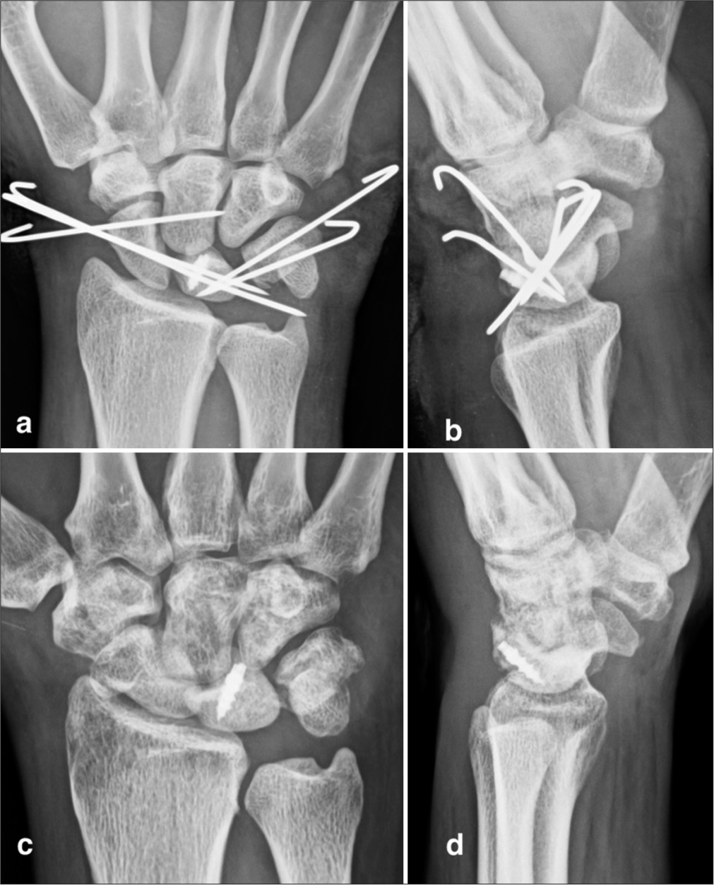 (a and b) Intraoperative images demonstrating open reduction of the lunate and scapholunate ligament repair using 3.5 mm suture anchors. Scaphocapitate and scapholunate K-wires provide additional stability. The lunotriquetral (LT) ligament was not repaired but the LT joint was immobilized with K-wires. (c and d) Two-year post-operative radiographs showing maintained carpal bone alignment with preserved scapholunate space. The patient reported being symptom-free at this follow-up.