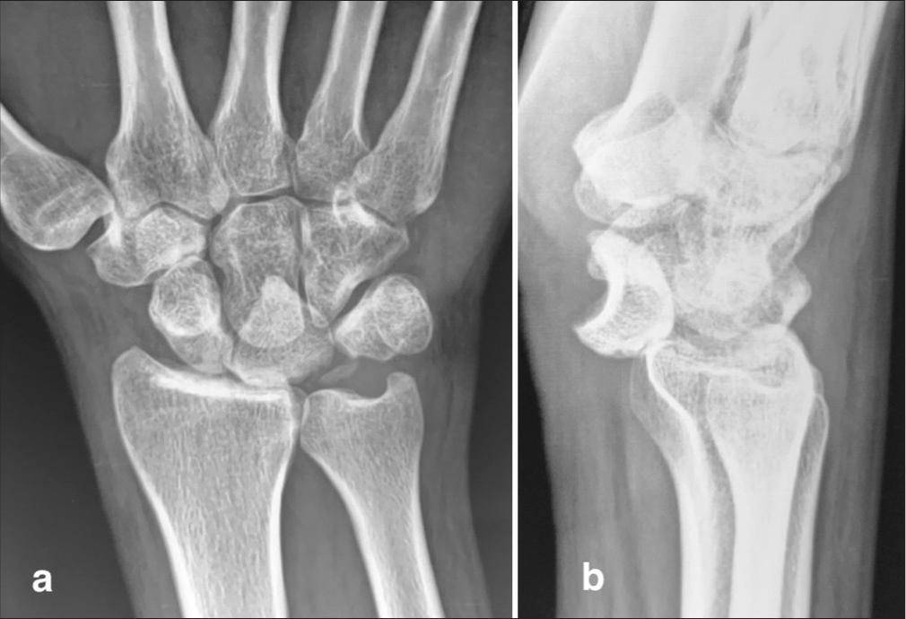 (a and b) Pre-operative radiographs of a 20-year-old man with a 3-month-old neglected perilunate dislocation of the right wrist, accompanied by median nerve dysfunction.