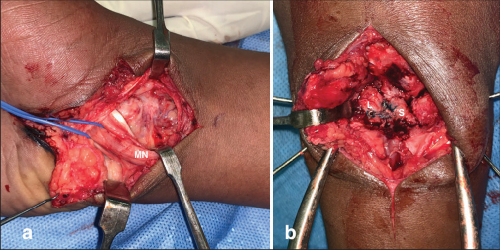 (a) Intraoperative image showing compression of the median nerve by the dislocated lunate, necessitating carpal tunnel release. (b) Intraoperative image demonstrating scaphoid (S), lunate (L) and scapholunate ligament reconstruction using two 3.5 mm suture anchors due to the absence of viable remnants of the dorsal scapholunate interosseous ligament.