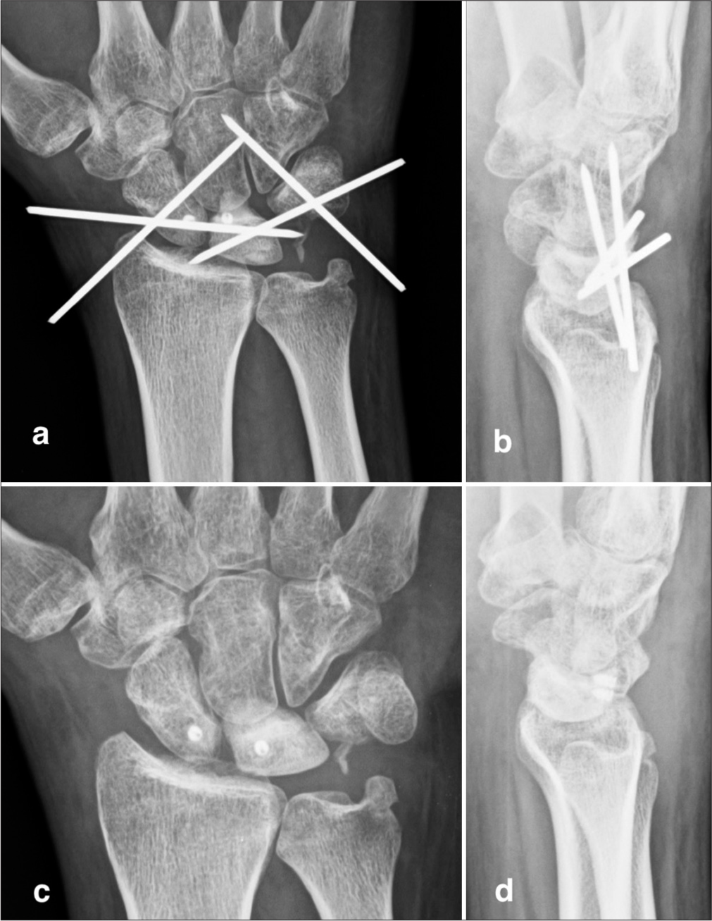 (a and b) Post-operative radiographs showing K-wire stabilization of the scapholunate and lunotriquetral joints and the triquetrum-hamate joint due to intraoperative ligament injury and subsequent instability. (c and d) Three-year follow-up radiographs of the same patient reveal an intact scapholunate space and a symptom-free status.