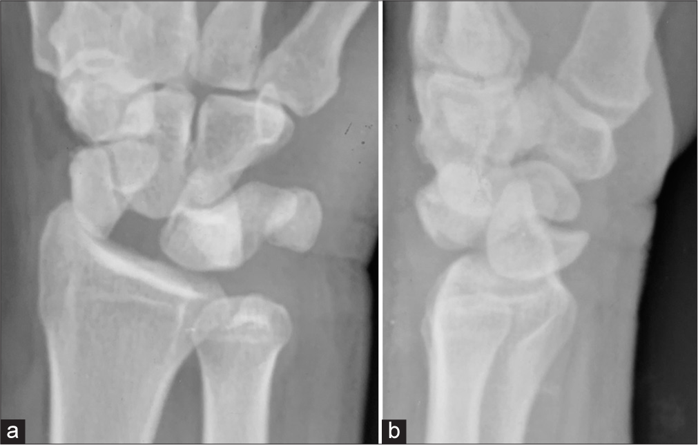 (a and b) Radiographs of a 46-year-old man with a 4-month-old perilunate dislocation of the right wrist.