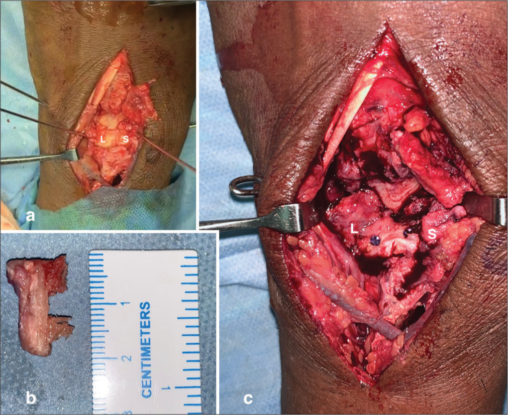 (a) Intraoperative image showing the absence of the dorsal scapholunate interosseous ligament (SLIL) and its remnants. A trough was created over the dorsal aspect of the lunate and scaphoid at the anatomical site of the dorsal SLIL. (b) A 2 cm bone-retinaculum-bone graft was harvested from Lister’s tubercle, including the retinaculum and distal radius with periosteum. (c) The bone-retinaculum-bone graft was inserted into the prepared trough and stabilized with two mini-screws, one in the scaphoid (S) and one in the lunate (L).