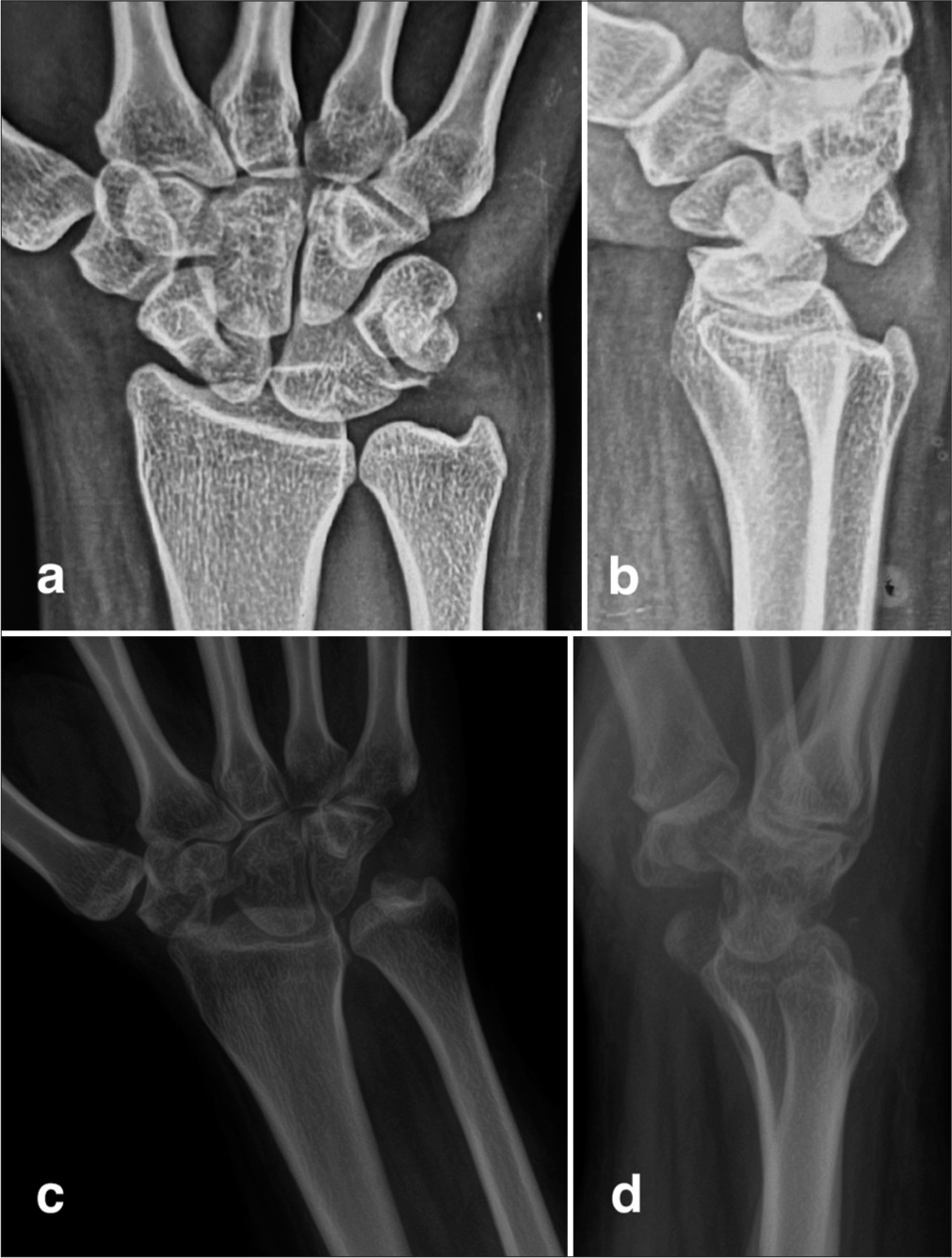 A 25-year-old woman presented with a 9-month history of persistent pain and stiffness in her left wrist, initially diagnosed as a wrist sprain following a fall. (a and b) Radiographs revealed a trans-scaphoid perilunate dislocation. (c and d) Due to intraoperative findings of irreducibility, instability, and loss of carpal ligaments, a proximal row carpectomy was performed, preserving an intact capitate. The patient achieved a good functional outcome at the 2-year follow-up.