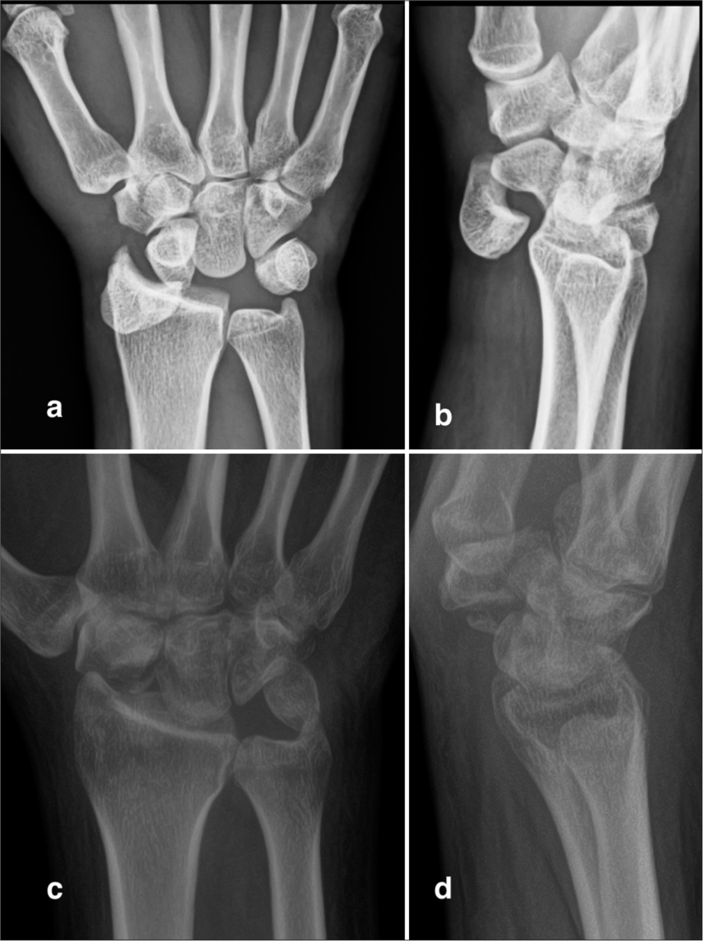 A 50-year-old woman presented with a 5-month history of persistent pain, median nerve dysfunction, and stiffness in her right wrist following a fall. (a and b) Radiographs revealed a total volar lunate dislocation. (c and d) Intraoperative findings of irreducibility, instability, and loss of carpal ligaments led to performing a proximal row carpectomy, preserving an intact capitate. The lunate was removed through a dorsal approach, indirectly decompressing the median nerve. The patient achieved a good functional outcome at the 3-year follow-up.