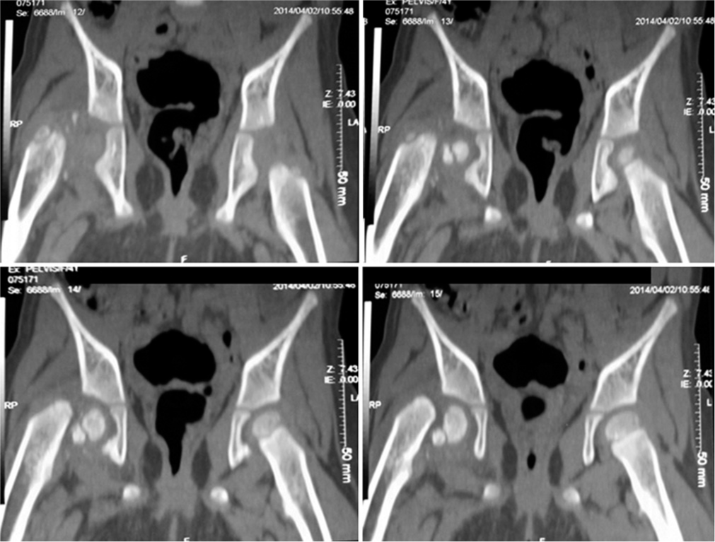 Coronal computed tomography images show superior displacement of the metaphysis with flecks of calcification and a possibly intact medial retinacular hinge.