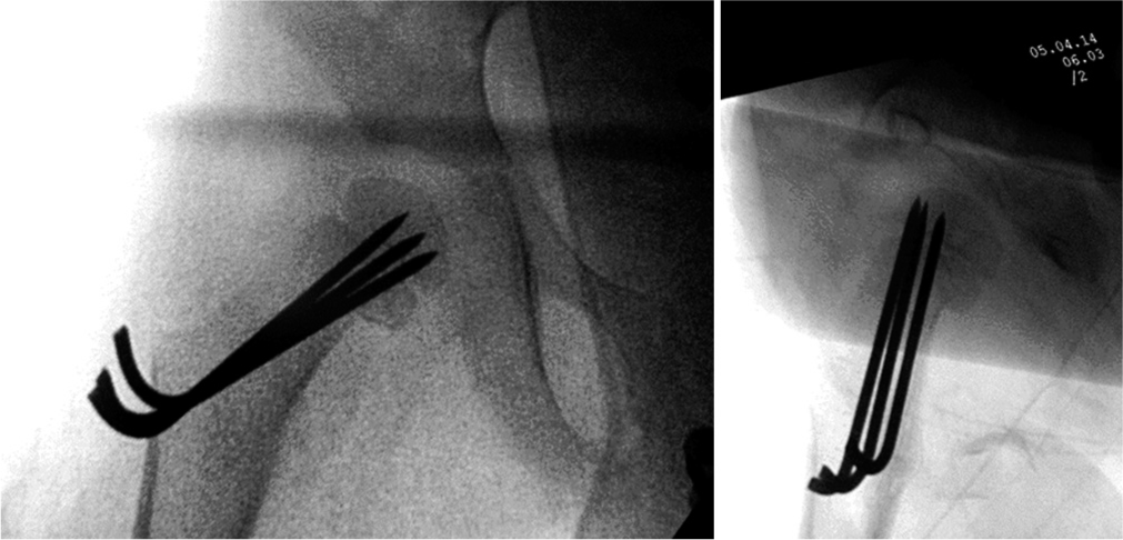 Fixation using three smooth Kirschner wires.