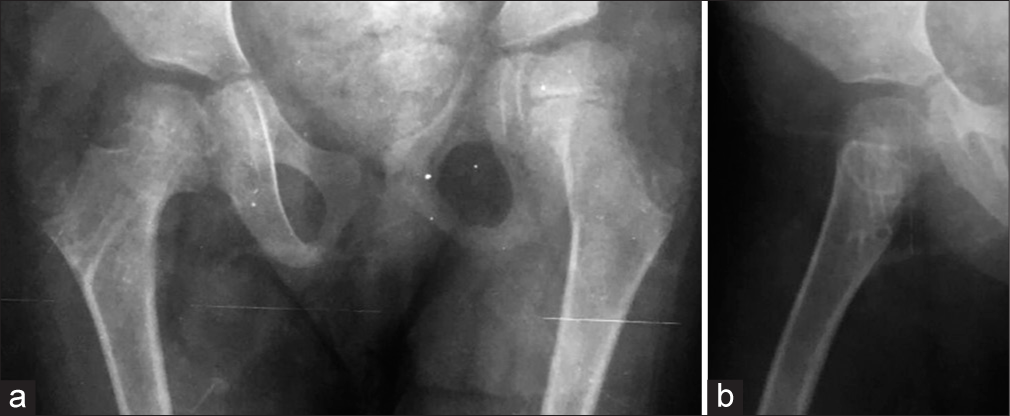 (a) Anteroposterior and (b) lateral follow-up radiographs 7 months post-op, right after Kirschner wires removal, with no signs of avascular necrosis.