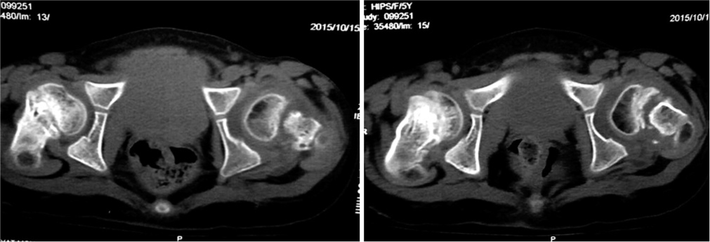 Computed tomography axial images show a left transphyseal injury with what seems like sclerosis of the proximal femoral metaphysis. These images also confirmed the union of the right side in an acceptable position.