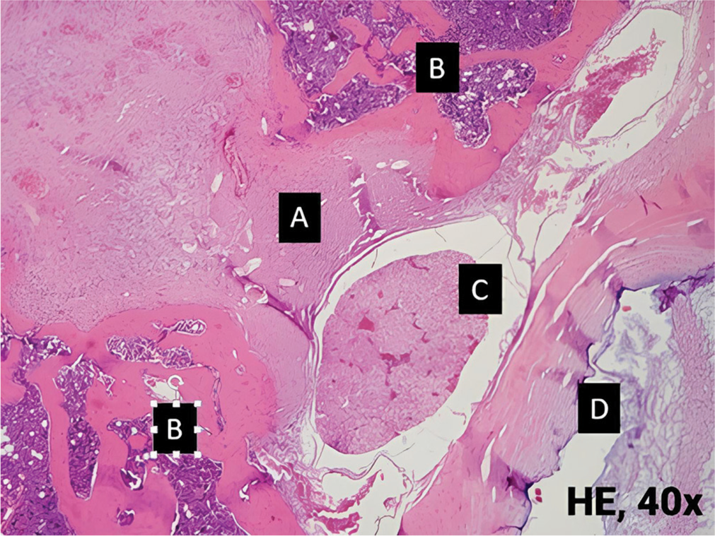 Histopathological view of grade III epidural fibrosis on Combination of Methylprednisolone and Fat group. (A): Epidural fibrosis, (B): Bone, (C): Cauda equina, (D): Vertebral body. HE: Hematoxylin and eosin.