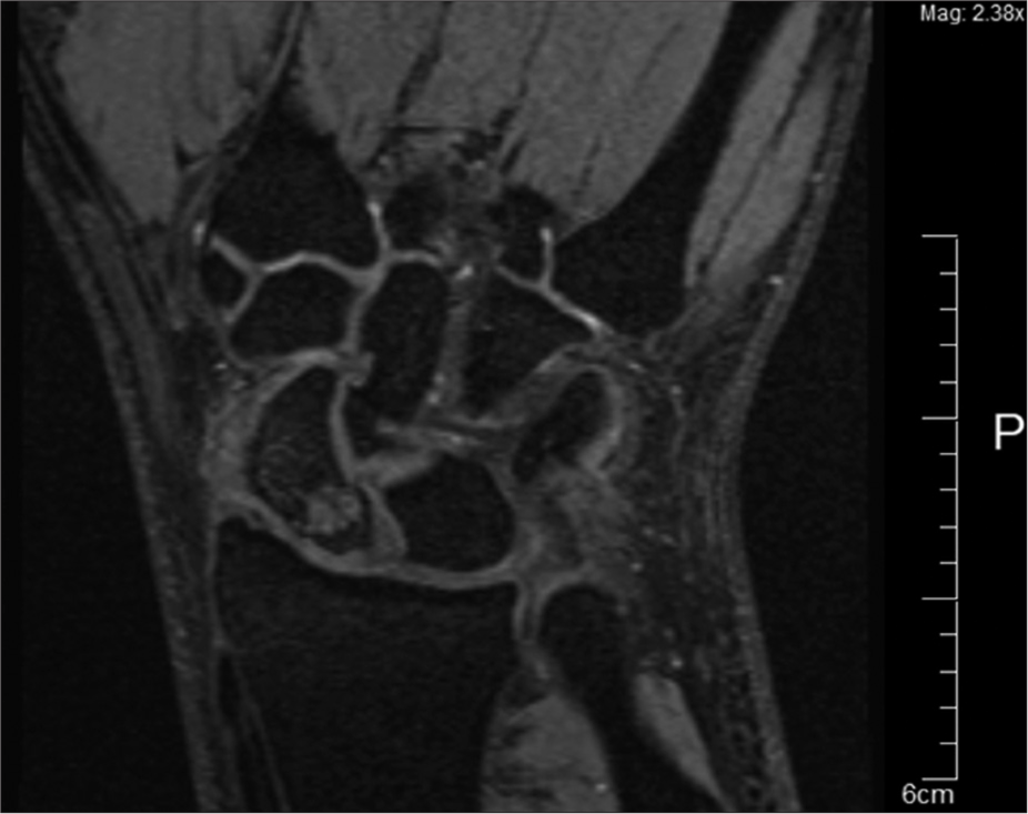 Magnetic resonance imaging of the left wrist confirming the fracture with cystic changes.