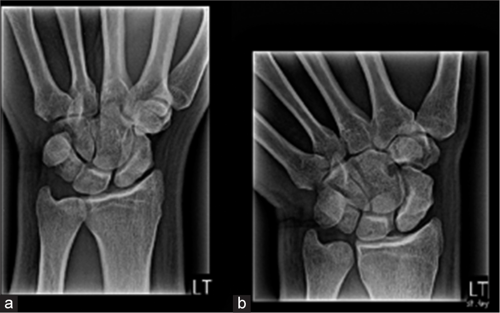 (a) Oblique and (b) AP radiographs of the left wrist taken 16 months after the first encounter.