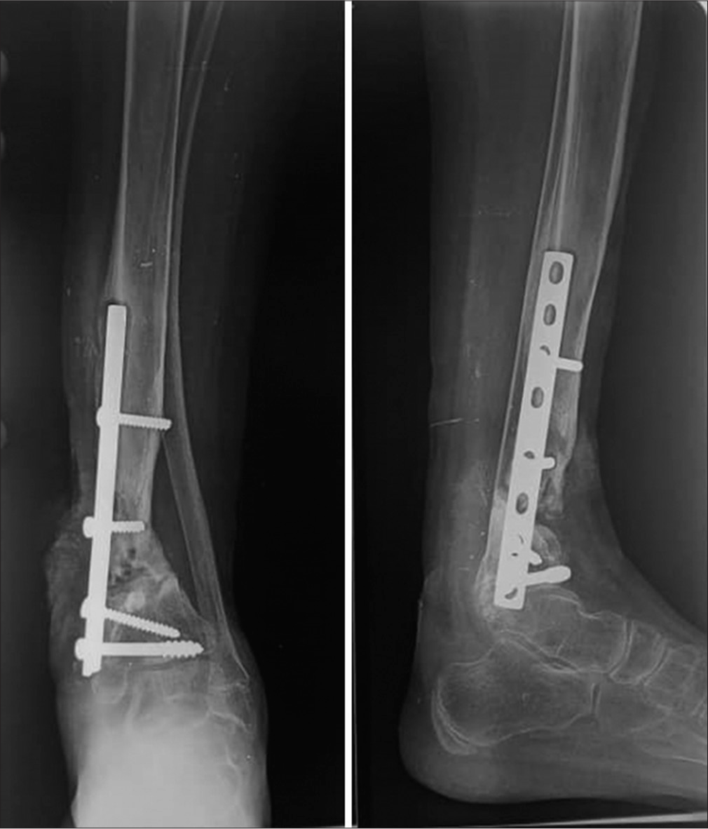 Non-union of tibia and epiphysiodesis of distal growth plate and single growth of the fibula after plate osteosynthesis. A child of 14-years-old.