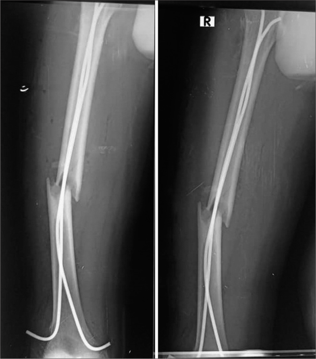 Diaphyseal non-union of femur after elastic stable intramedullary nail. A child of 13 years old. Non-union was caused by early walking (though the nail diameter was smaller than optimal).
