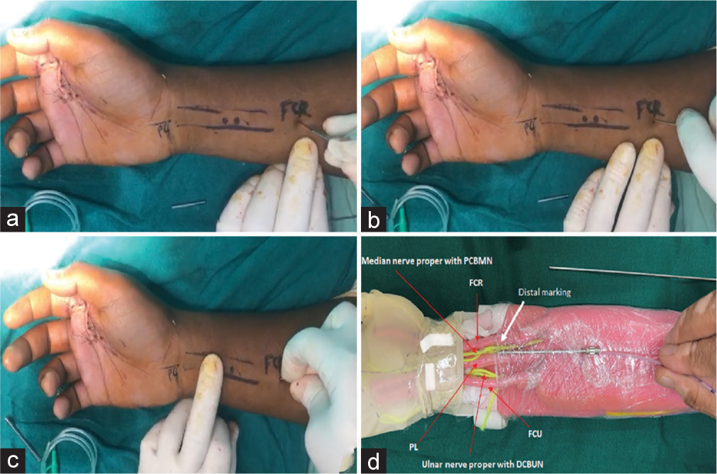 (a) After wound closure, the distal three tendons are marked. Incision at the proximal marking point. (b) Passage of blunt 2 mm K-wire. (c) The needle passed through the incision at the proximal marking point. (d) Depiction is shown using a hand and forearm model.