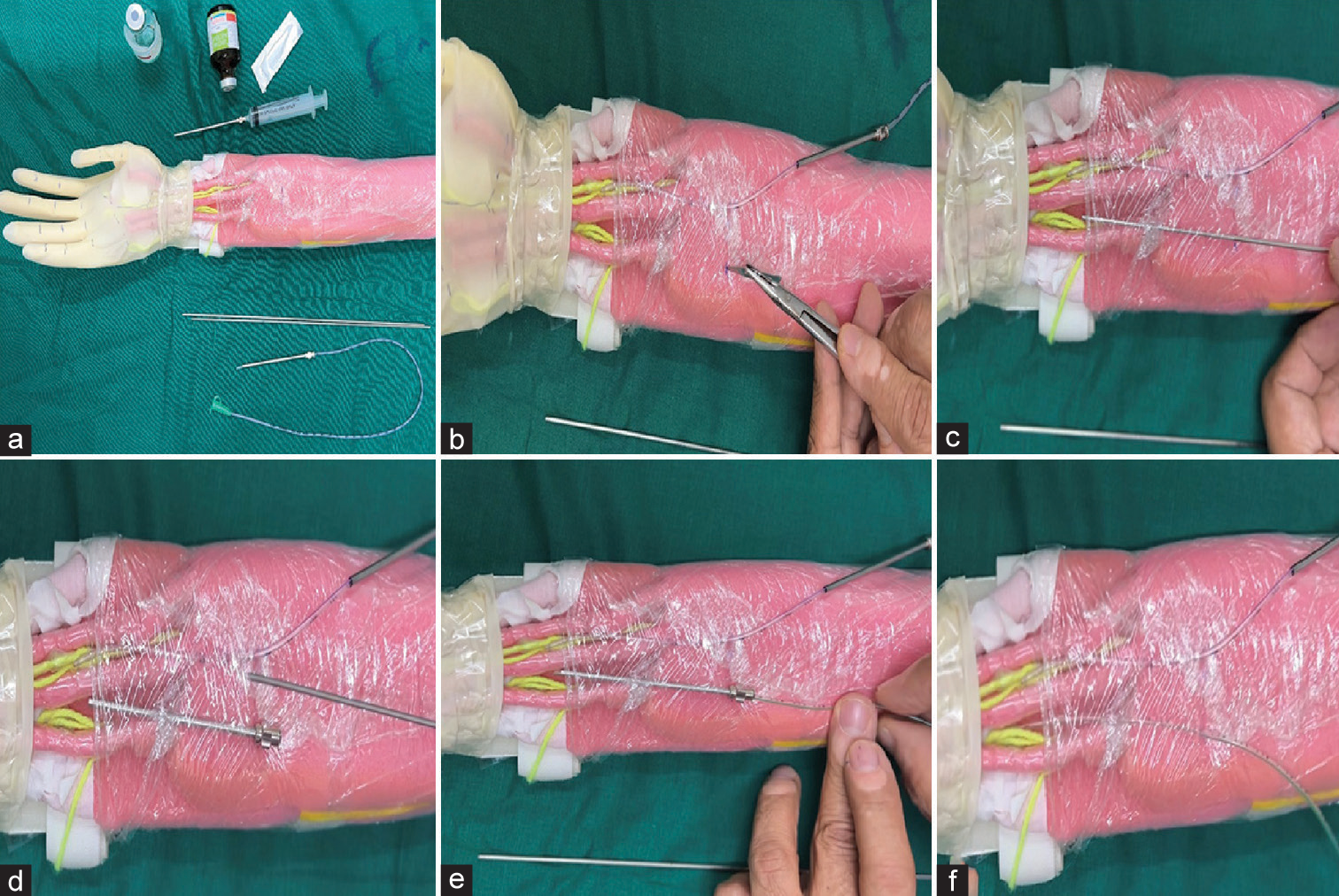 (a) Pictorial depiction of blocking ulnar nerve using a model with the required equipment. (b) Incision made at the proximal marking point. (c) Negotiation of K-wire under the deep fascia. (d) Needle in situ after removing the wire. (e) Insertion of the infant feeding tube. (f) Showing infant feeding tube is in the appropriate place.