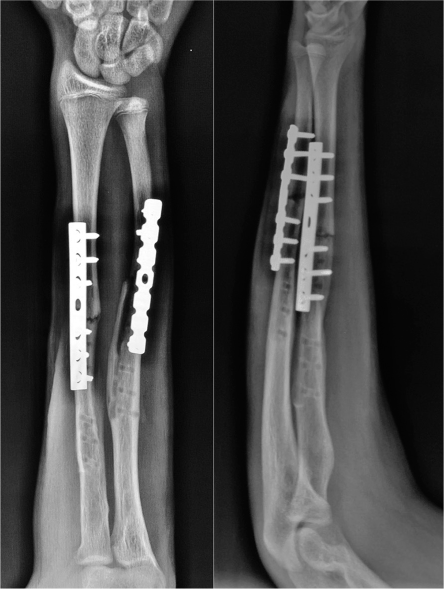 Immediate postoperative AP and lateral views.