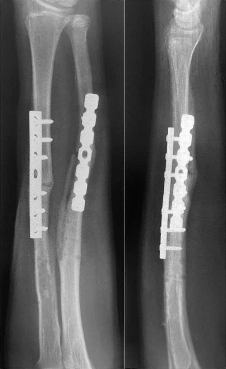 AP and lateral views 2 months after surgery.