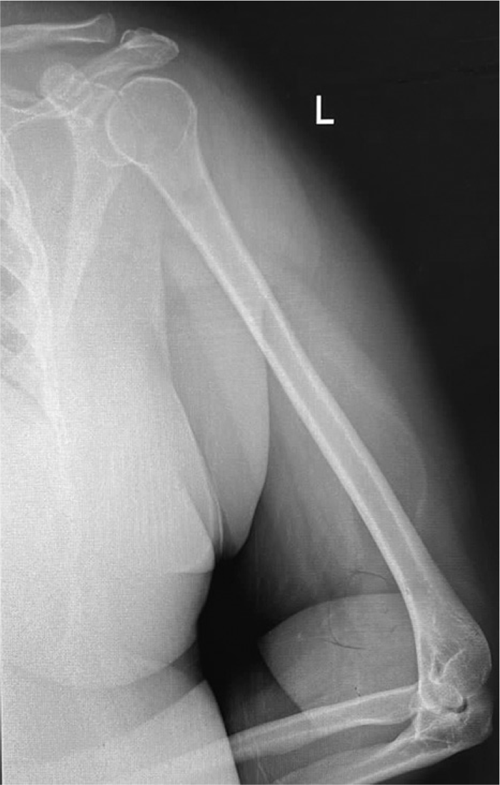 A plain radiograph of the left humerus shows soft-tissue shadows with septations over the distal anterior arm and just posterior to this septation. There is tiny cortical radiolucency.