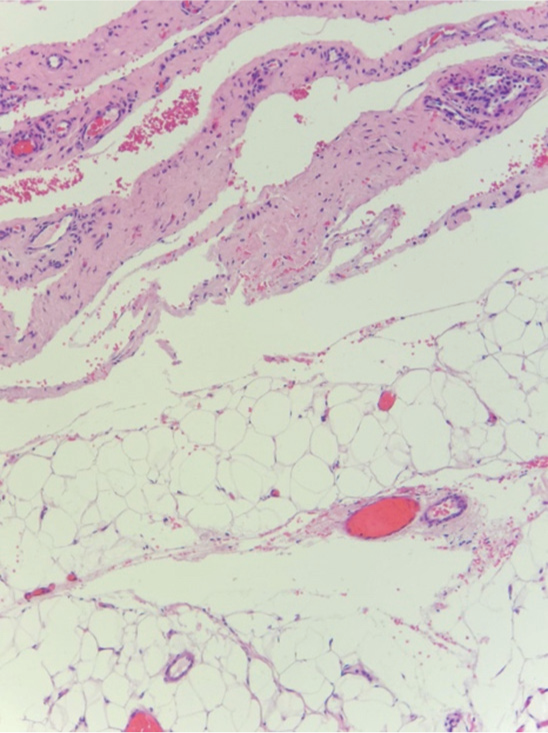 Another slice from the tissue sample showed mature adipose surrounded by fibrous tissue (periosteum) consistent with parosteal lipoma.