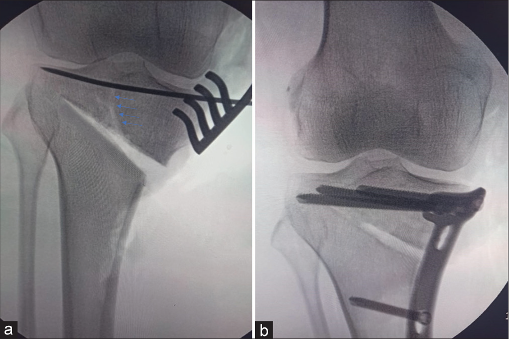 (a) Intra-articular fracture (blue arrows) during gap opening where displacement was prevented by the subchondral Kirschner wires. (b) Definite fixation of intra-articular fracture during high tibial osteotomy using the TomoFix plate.