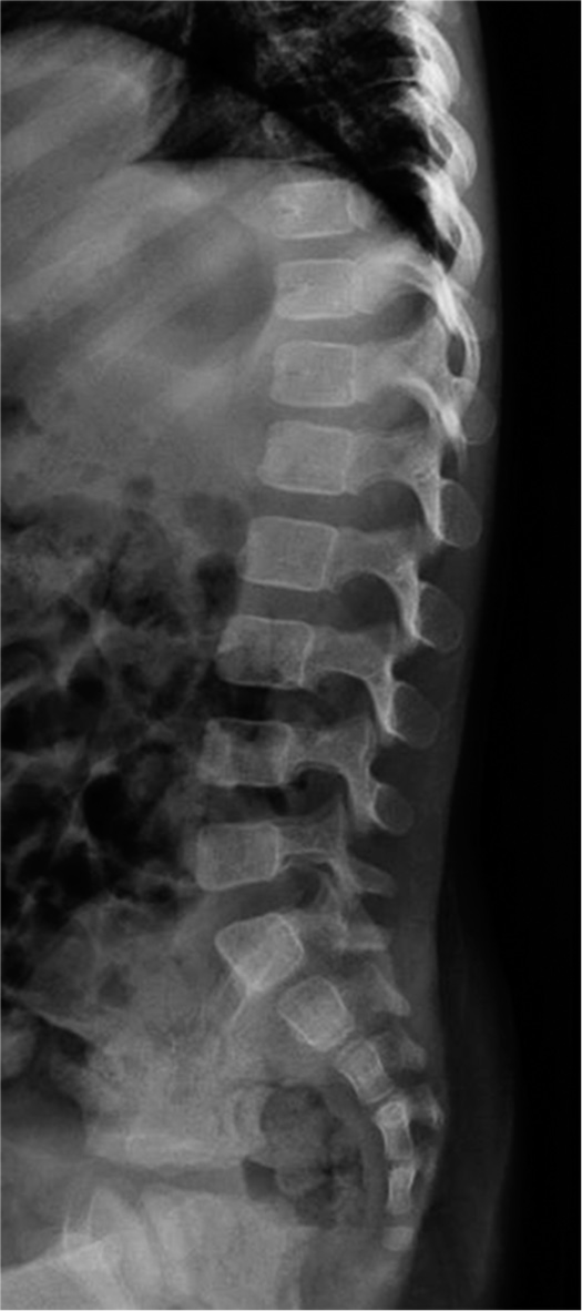 Lateral plain radiographs show no structural alterations of the spine.