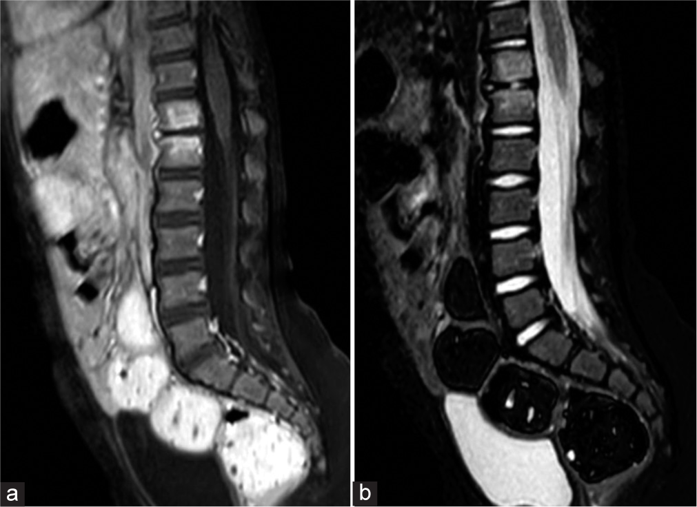 (a) Sagittal T1- and (b) T2-weighted magnetic resonance images of the lumbar spine demonstrate T1 hypointensity and T2 hyperintensity centered around the T12–L1 disc space consistent with bone marrow edema and intervertebral disc space fluid.