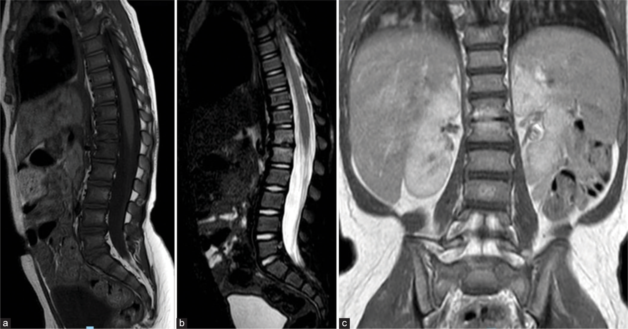 One-month follow-up sagittal (a) T1, (b) T2-weighted, and (c) coronal T1-weighted magnetic resonance images of the lumbar spine reveal hyperintensity centered around the T12–L1 disc space consistent with bone marrow edema and no evidence of paraspinal abscesses, spinal cord compressions or increase in thoracolumbar junction kyphosis.