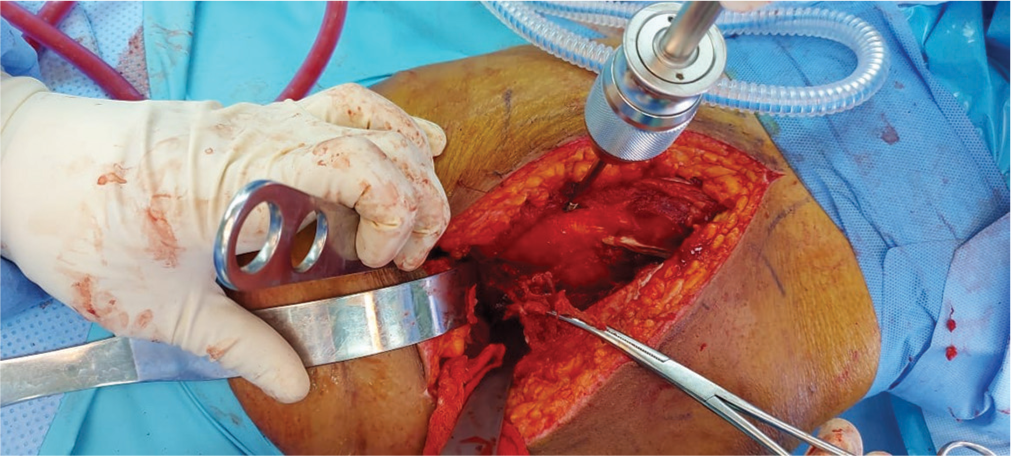 Intraoperative image Kocher-Langenbeck approach to the right hip shows gluteus maximus tendon held in the forceps ruptured from its femoral insertion.