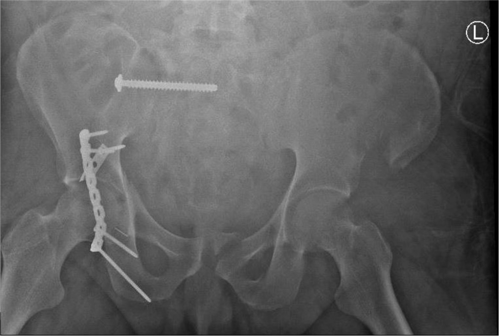 Postoperative AP pelvis radiograph shows fixation of the right sacrum screw and right hip posterior wall with spring plate, buttress plate, and capsular fixation to the ischium through anchor suture.
