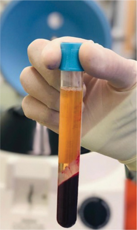 The extracted platelet-rich plasma after centrifuging.