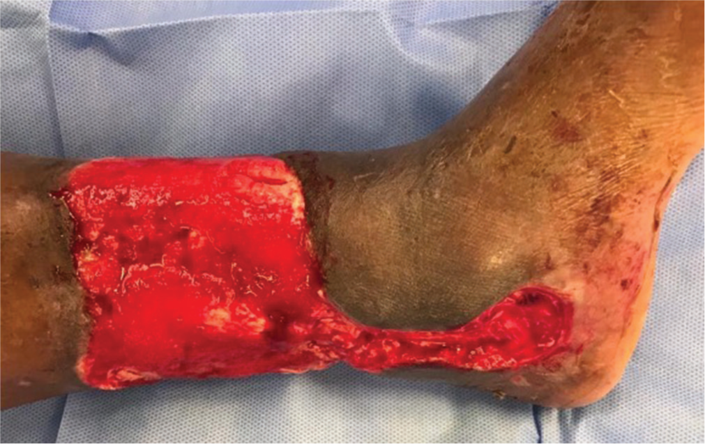 Immediate Post-Op image after the second debridement after the initiation of the platelet-rich plasma (PRP) therapy, with bone drilling and second dose PRP.