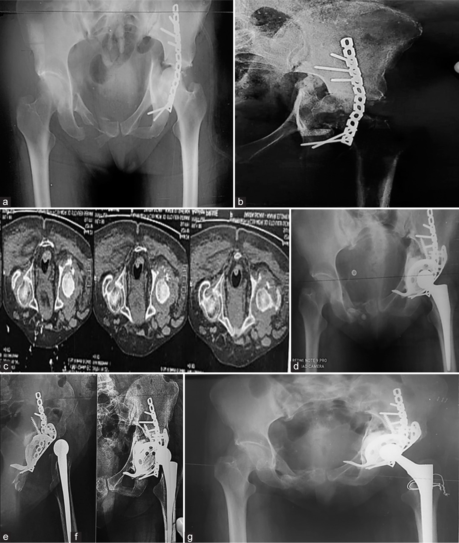 (a) Anteroposterior (AP) radiograph of the pelvis showing transverse left (Lt) acetabular fracture fixed by plate and screws of a 59-year-old female, (b) acetabular defect classified as American Academy of Orthopedic Surgeons type IIIb, (c) axial cuts of the Lt hip showing the acetabular defect, (d) total hip arthroplasty (THA) (cemented cup and cementless stem) with autograft and Burch-Schneider ring to reconstruct the acetabular defect. (e) AP radiograph, (f) lateral radiograph of the hip, 10 months after THA, showing prosthetic dislocation with stem loosening, and (g) revision of the stem by a long cementless stem and cerclage due to greater trochanter fissure fracture.