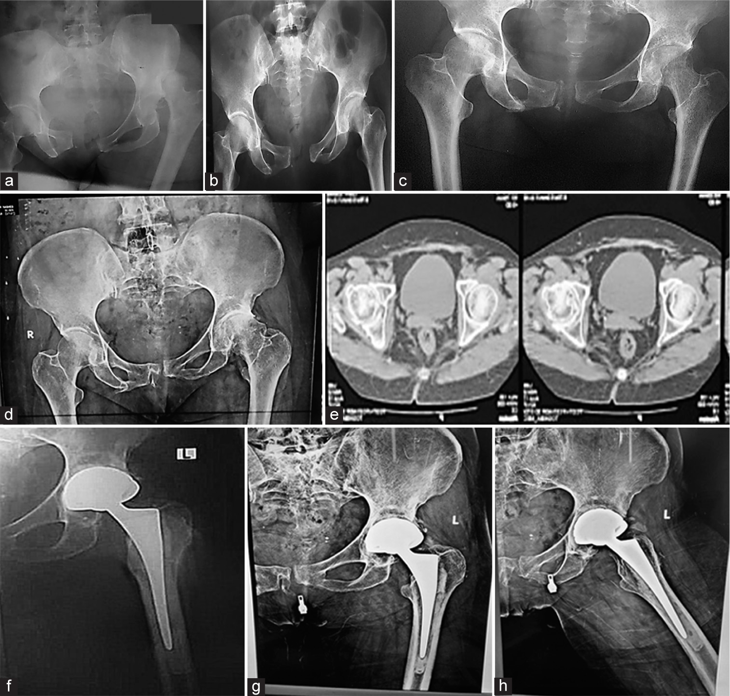 (a) Anteroposterior (AP) radiograph of both hips showing left (Lt) acetabular posterior wall fracture-dislocation of a 69-year-old female patient at the time of accident 28-years-ago, (b) reduction of dislocated Lt hip after closed reduction and skeletal traction, (c) after 1 year from the fracture showing united acetabular fracture and osteoarthritis (OA) of the hip, (d) OA Lt hip after 28 years from the trauma, (e) computed tomography axial cuts before arthroplasty showed minimal rim defect of the posterior wall, (f) immediately postoperatively of Lt hip shows cemented dual mobility, (g) AP, and (h) lateral radiograph of the Lt hip, after 18 months of the arthroplasty, shows a radiolucent line around the superior aspect of the cup, stable prosthesis, and heterotopic ossification grade I.