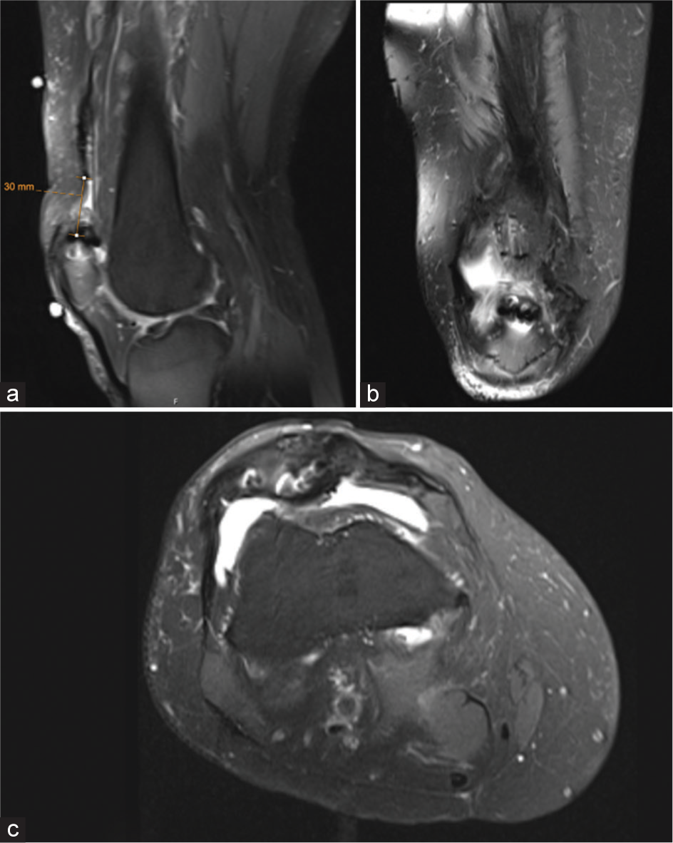 67-year-old male following quadriceps tendon repair failure. (a) Sagittal MRI demonstrates the tendon rupture proximal to the patella with 30 mm of retraction of the quadriceps tendon. (b) Coronal and (c) axial views demonstrate evidence of prior suture anchor fixation.