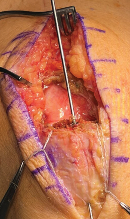 67-year-old male following quadriceps tendon repair failure undergoing revision reconstruction. Exposed patella with a middle guidewire in place. Medial and lateral tunnels have been drilled, reamed, and dilated, with passing suture placed in the tunnels.