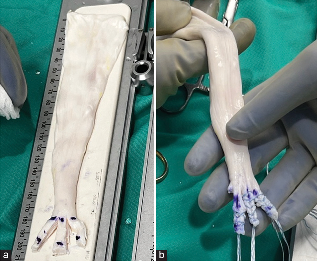 Preparation of Achilles allograft without bone block demonstrating equal-sized limbs in length and width (a) before and (b) after being whipstitched and sized to 5 mm in diameter.