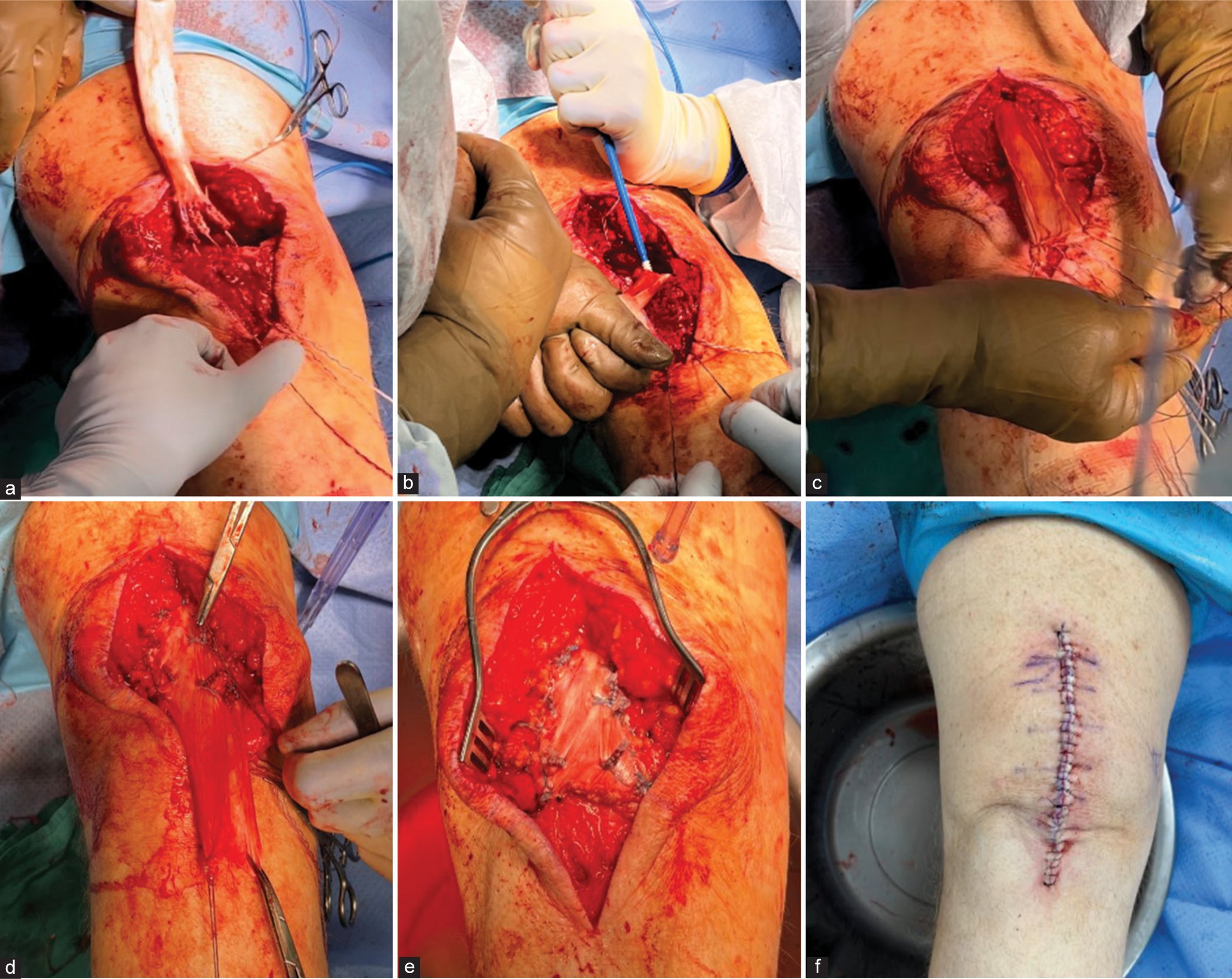 67-year-old male following quadriceps tendon repair failure undergoing revision reconstruction. (a) Introduction of the allograft using the whipstitch suture limbs of the graft passed through transosseous tunnels in the patella. (b) After graft limbs are shuttled into the patellar tunnels and tensioned, the graft is fixed proximally with a suture anchor. (c) The unprepared proximal portion of the graft is passed through a transverse rent made in the native viable quadriceps tendon. (d) The graft is held using tension sutures at the appropriate length to approximate native quadriceps tension, (e) Then the Achilles graft is folded over itself, tensioned, and fixed with a non-absorbable suture. (f) The wound is closed in a multi-layer fashion before being placed into a controlled range of motion hinged knee brace.