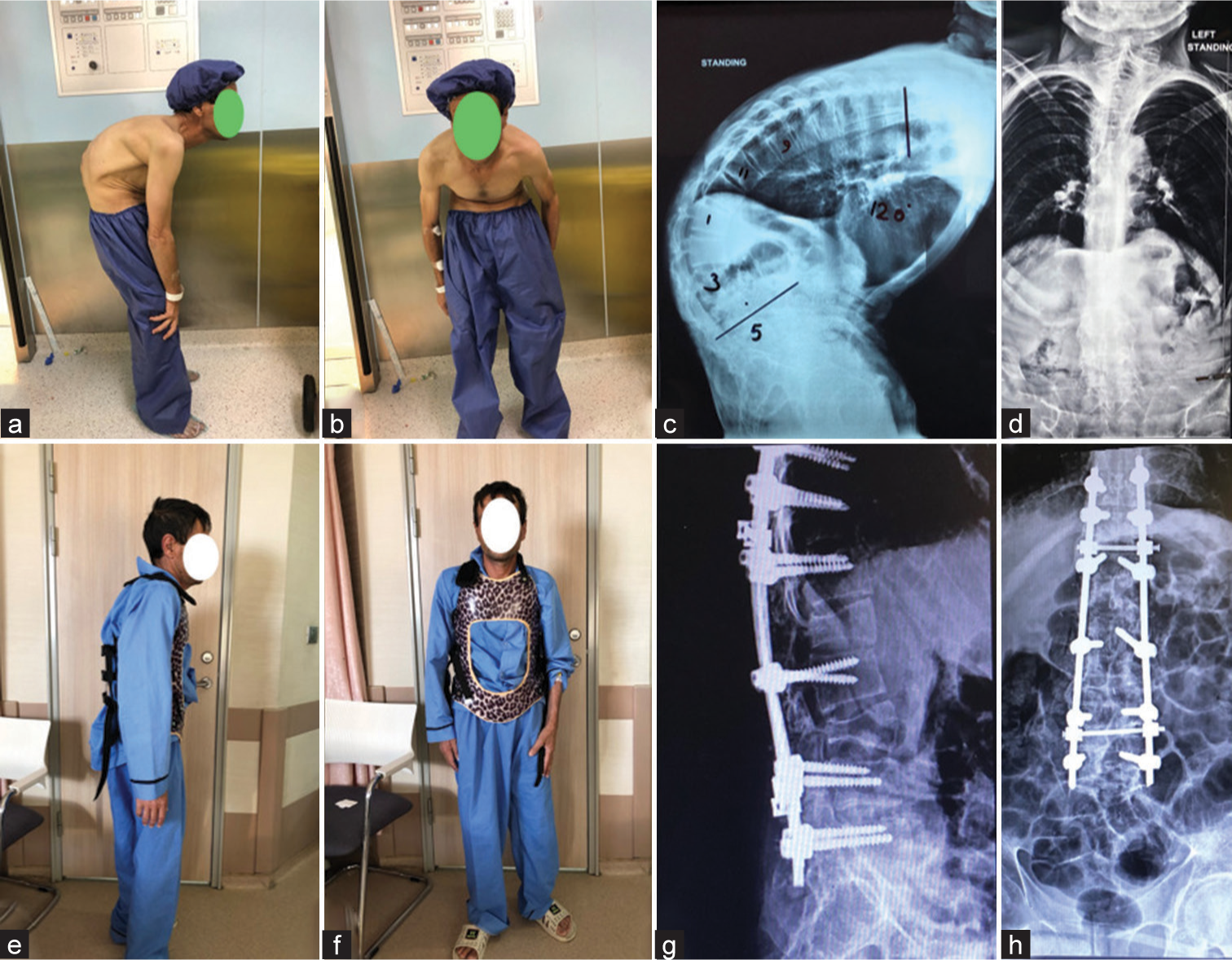 Pre-operative (a-d) and post-operative (e-h) images of a patient with severe fixed thoracolumbar kyphosis who underwent two-level pedicle subtraction osteotomy (PSO) at L1 and L3. Two-level PSO could efficiently restore center of mass to cone of economy.