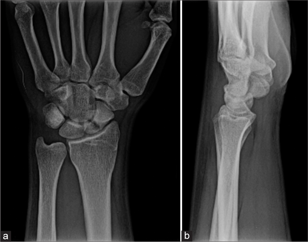 (a) AP and (b) lateral radiographs of the left wrist taken at the first patient encounter confirming evidence of displaced scaphoid fracture.