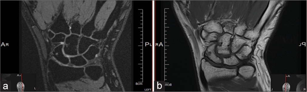 (a and b) Magnetic resonance imaging taken more than 26 months post initial encounter confirming the complete union of the neglected proximal pole left scaphoid fracture.