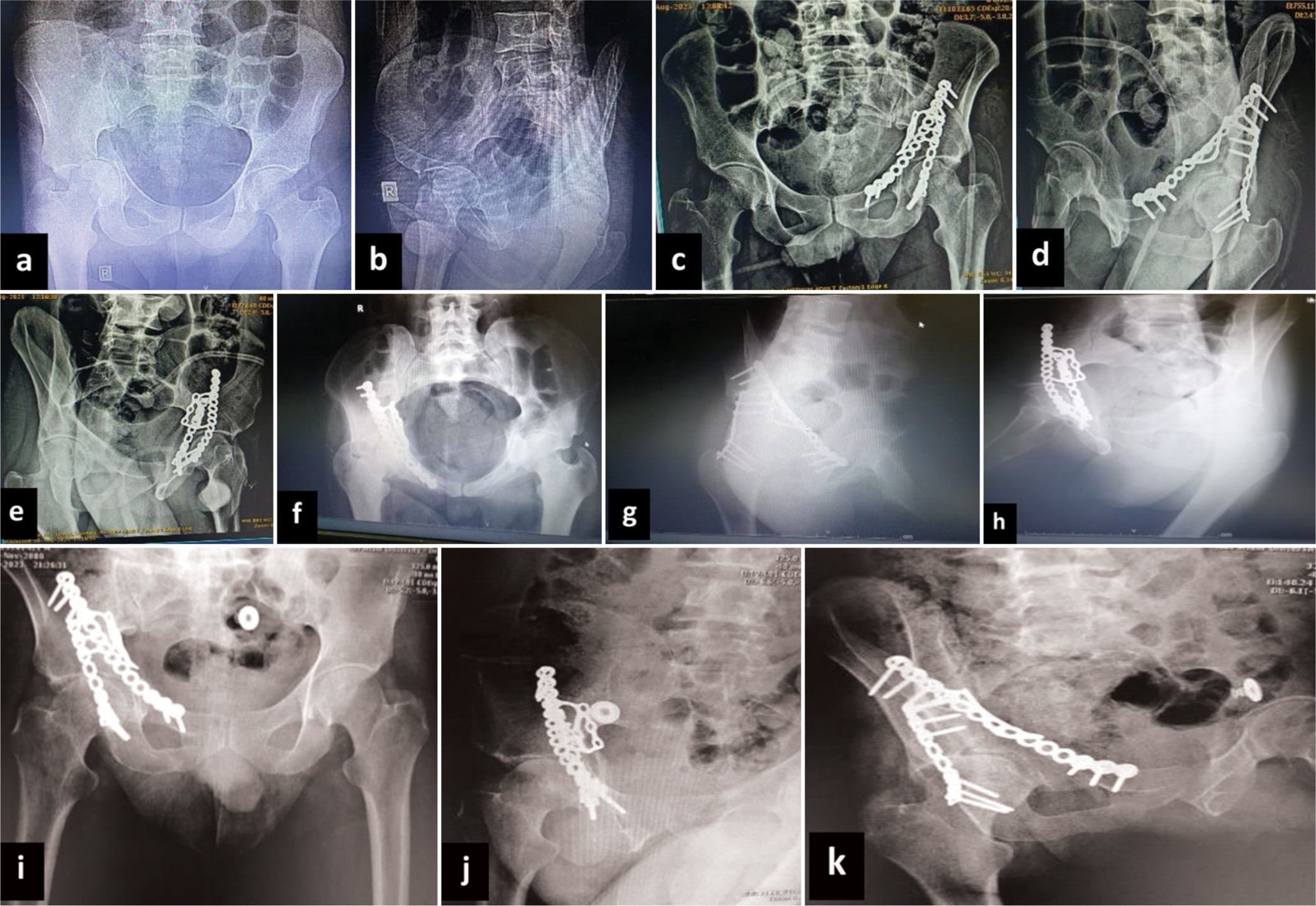 A 35-year-old male patient, after road traffic accident, (a and b) pre-operative radiographs demonstrating acetabular transverse fracture, (c-e) post-operative radiographs showing fixation through modified Stoppa approach, (f-h) radiographs 6 months postoperatively, and (i-k) radiographs 12 months postoperatively.