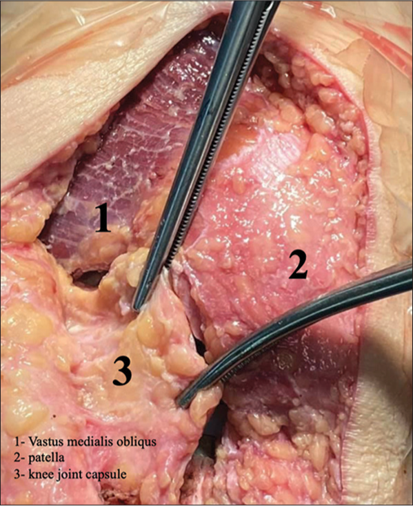 Closure with intact vastus medialis oblique muscle.